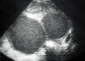 endometriosis ultrasound