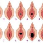 Types of hymen shapes