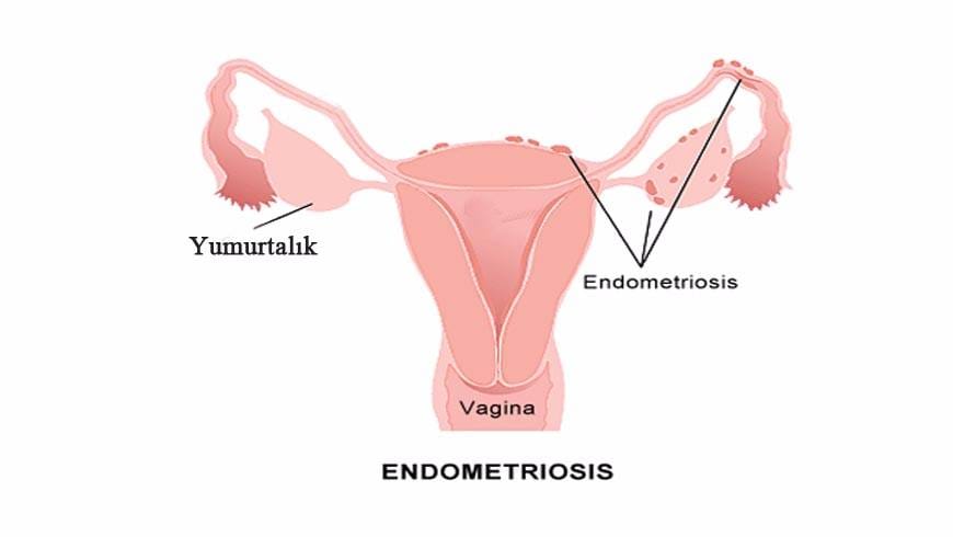 Endometriosis