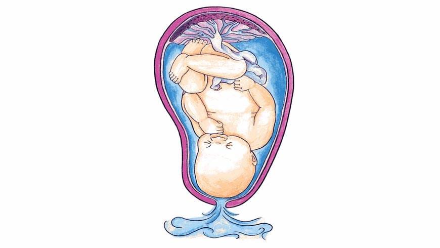 Early Membran Rupture