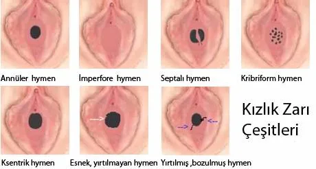hymen examination" 